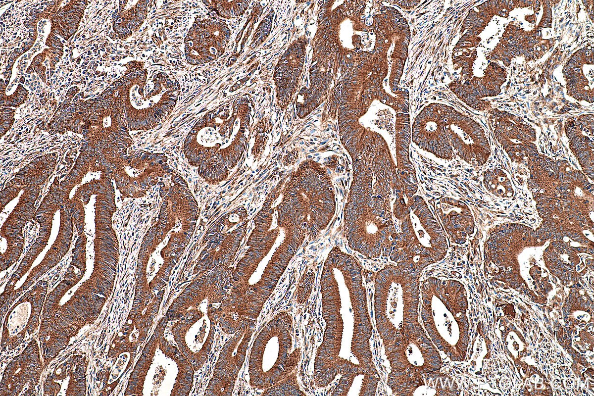 Immunohistochemical analysis of paraffin-embedded human colon cancer tissue slide using KHC0366 (MYO1A IHC Kit).