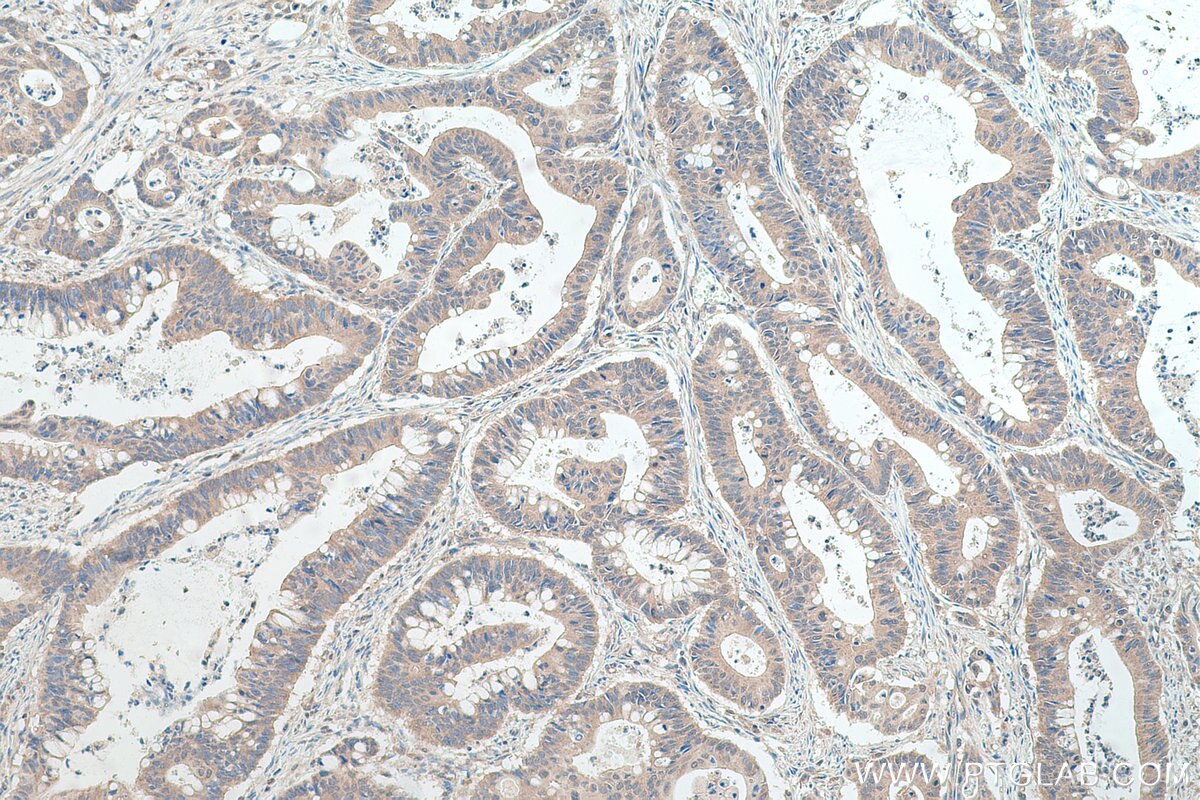Immunohistochemical analysis of paraffin-embedded human colon cancer tissue slide using KHC0367 (MYO1B IHC Kit).
