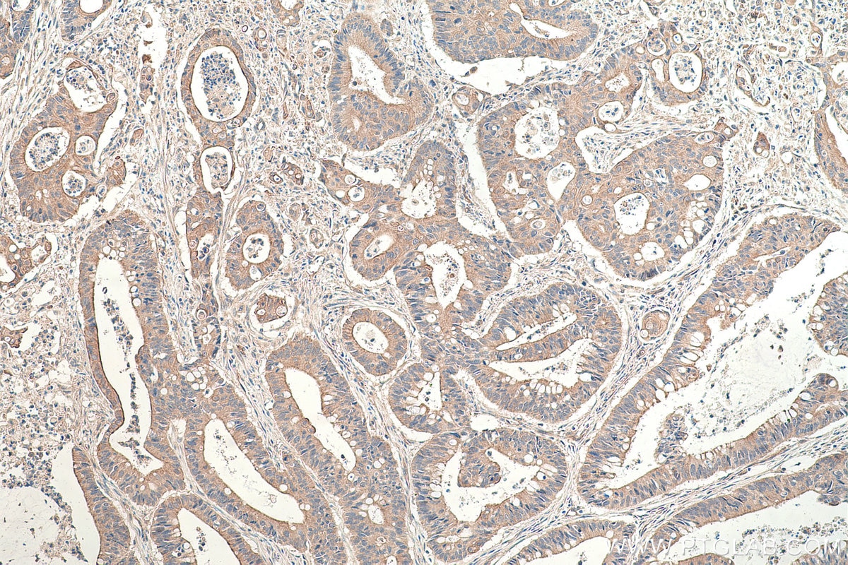 Immunohistochemical analysis of paraffin-embedded human colon cancer tissue slide using KHC0353 (MYO1C IHC Kit).
