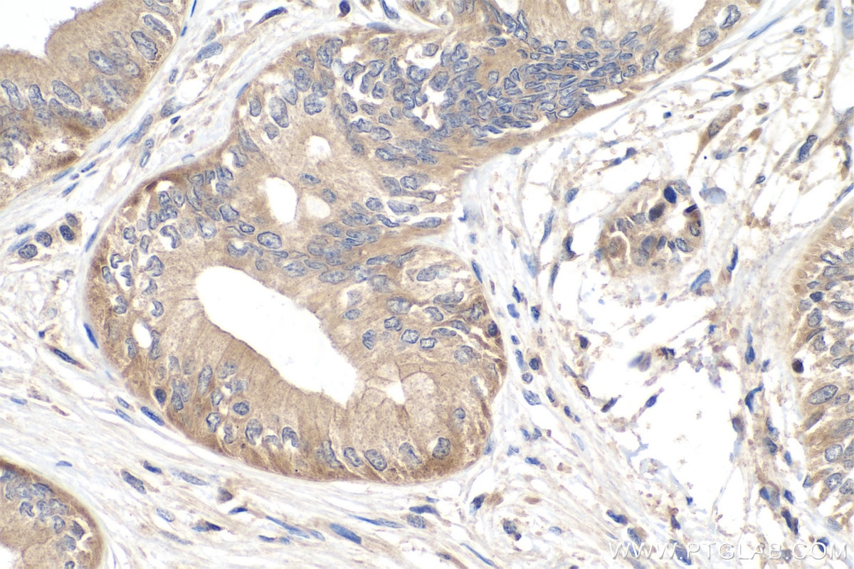 Immunohistochemical analysis of paraffin-embedded human pancreas cancer tissue slide using KHC0355 (MYO3A IHC Kit).