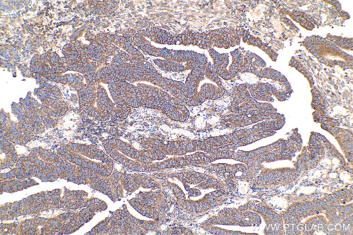 Immunohistochemical analysis of paraffin-embedded human colon cancer tissue slide using KHC0356 (MYO5B IHC Kit).