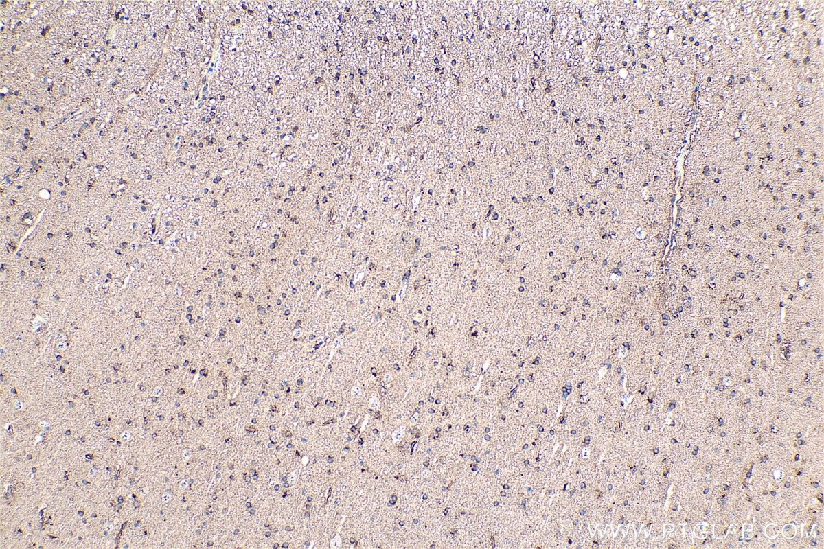 Immunohistochemical analysis of paraffin-embedded human gliomas tissue slide using KHC0357 (MYO6 IHC Kit).