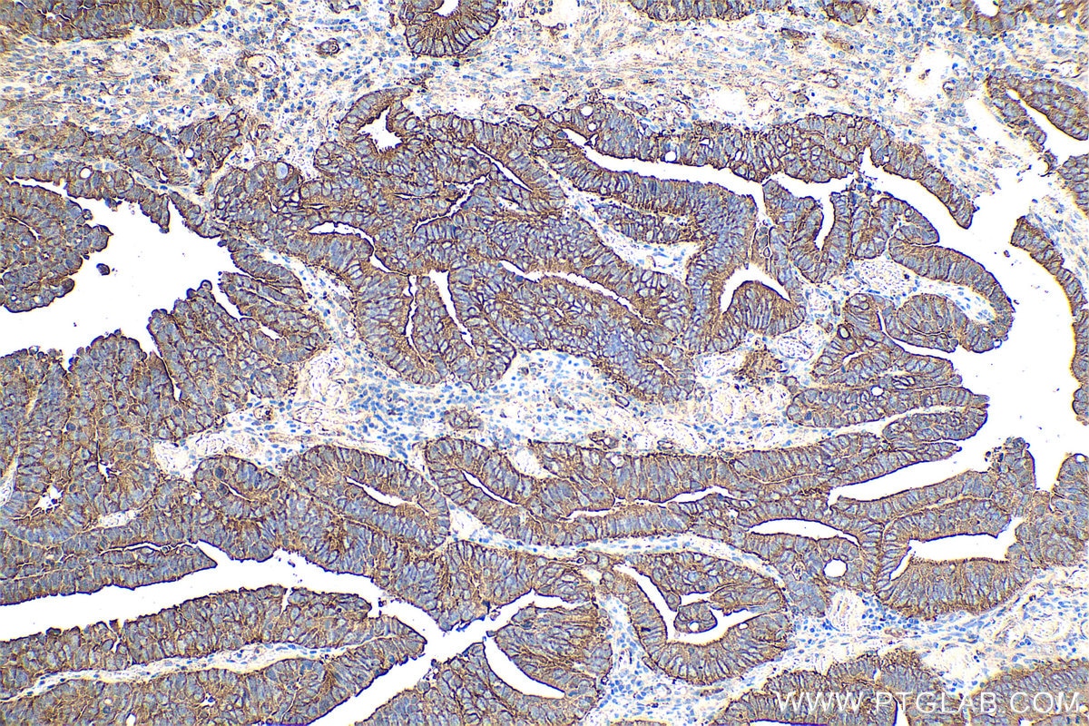 Immunohistochemical analysis of paraffin-embedded human colon cancer tissue slide using KHC0357 (MYO6 IHC Kit).