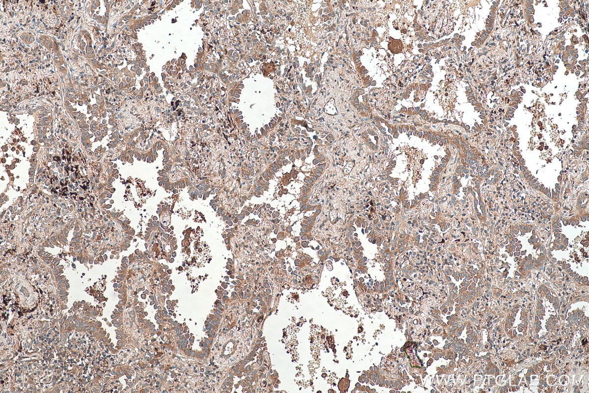 Immunohistochemical analysis of paraffin-embedded human lung cancer tissue slide using KHC0371 (MYO9B IHC Kit).