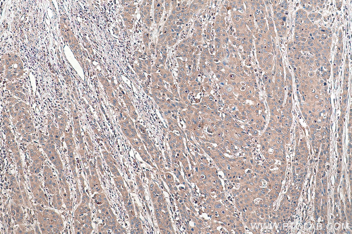 Immunohistochemical analysis of paraffin-embedded human oesophagus cancer tissue slide using KHC0371 (MYO9B IHC Kit).
