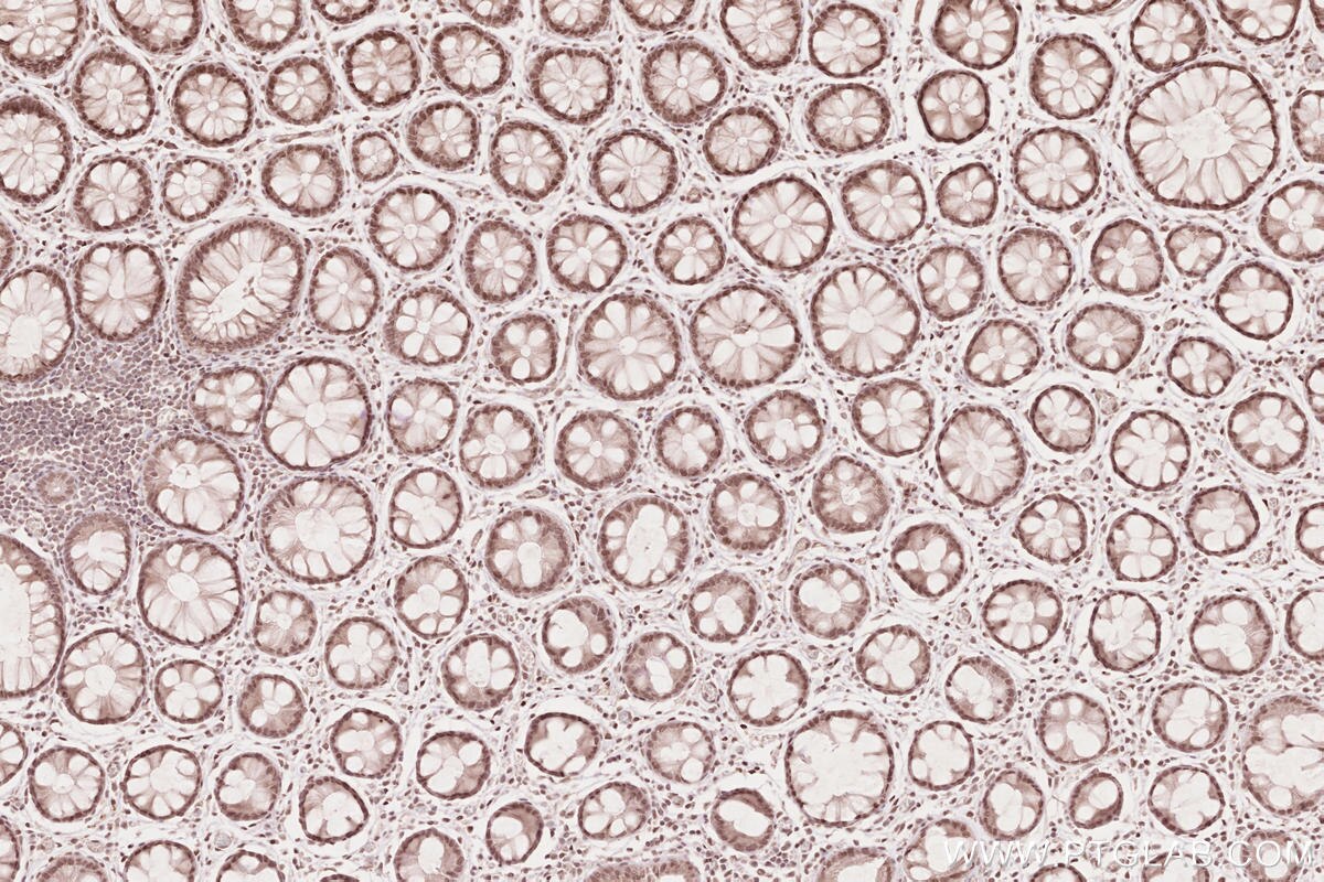 Immunohistochemical analysis of paraffin-embedded human rectal cancer tissue slide using KHC2632 (MYPN IHC Kit).