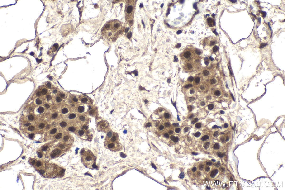 Immunohistochemical analysis of paraffin-embedded human urothelial carcinoma tissue slide using KHC1781 (MYSM1 IHC Kit).