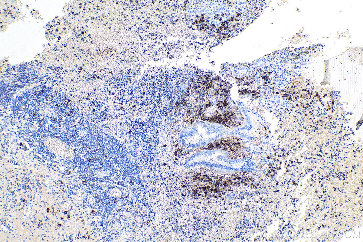 Immunohistochemical analysis of paraffin-embedded human appendicitis tissue slide using KHC0632 (MZB1 IHC Kit).