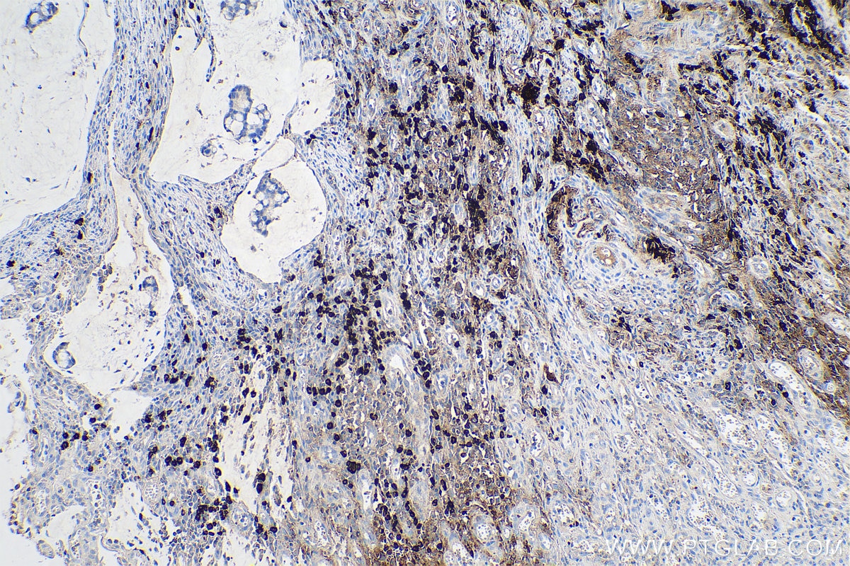 Immunohistochemical analysis of paraffin-embedded human colon cancer tissue slide using KHC0632 (MZB1 IHC Kit).