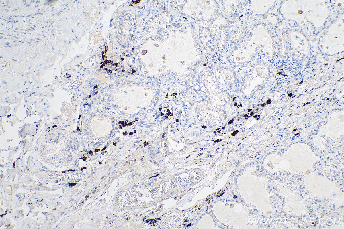 Immunohistochemical analysis of paraffin-embedded human lung cancer tissue slide using KHC0632 (MZB1 IHC Kit).