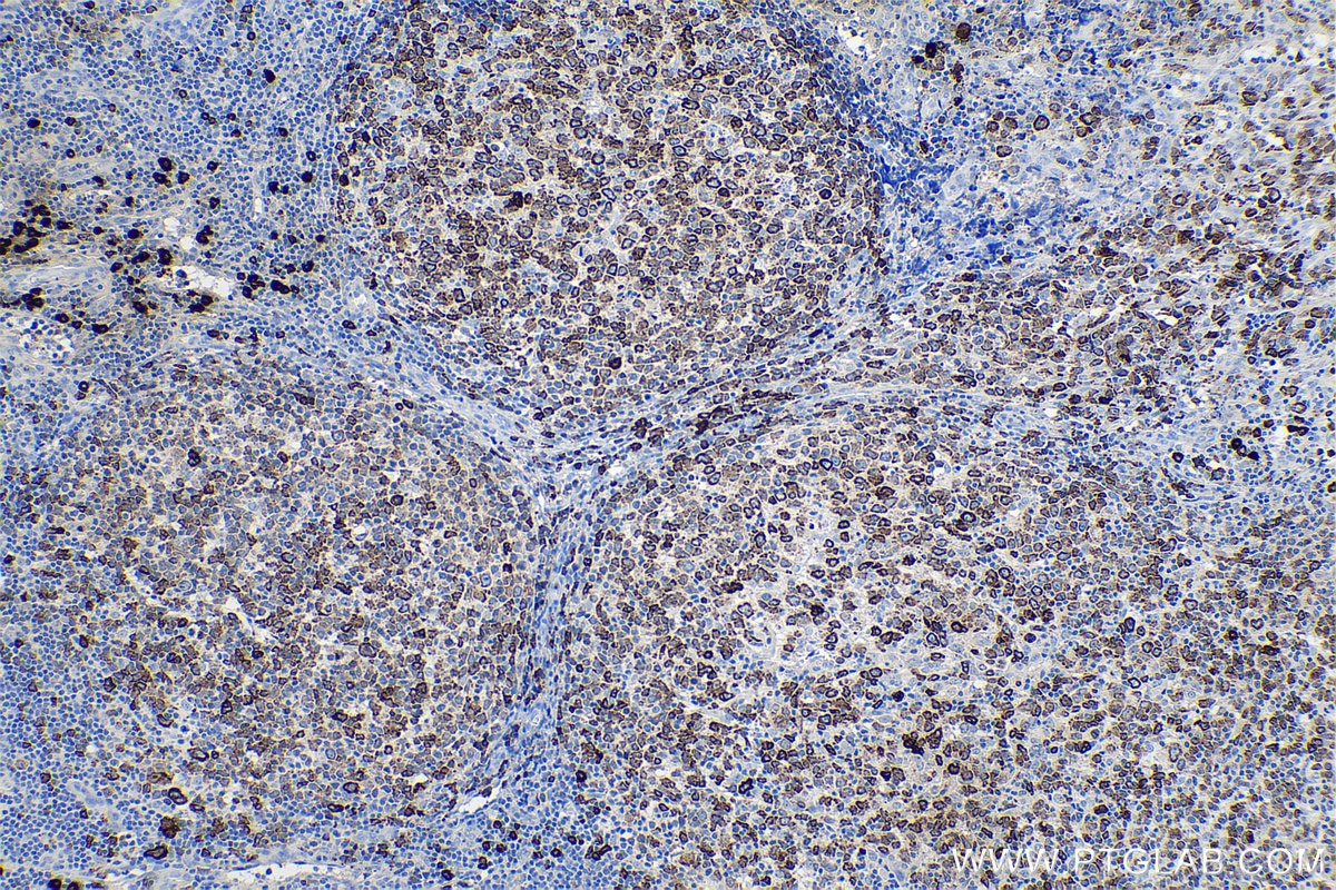 Immunohistochemical analysis of paraffin-embedded human lymphoma tissue slide using KHC0632 (MZB1 IHC Kit).