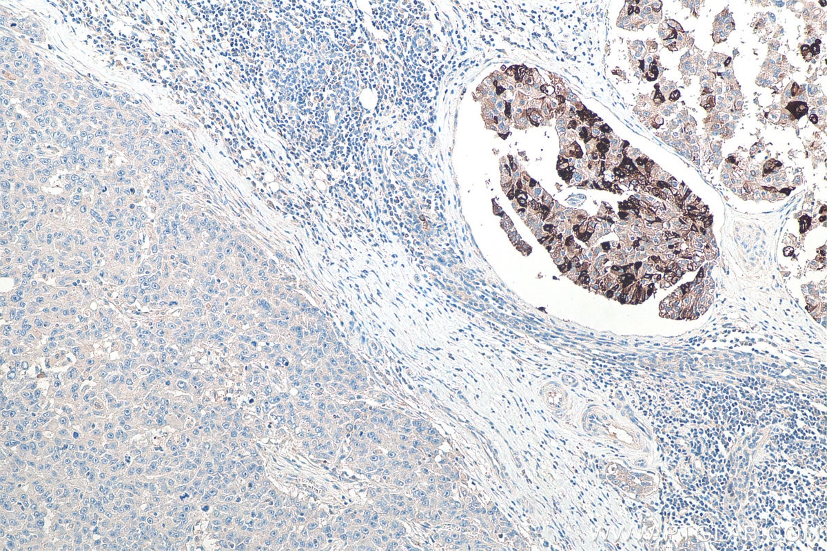 Immunohistochemical analysis of paraffin-embedded human breast cancer tissue slide using KHC0096 (Mammaglobin A IHC Kit).