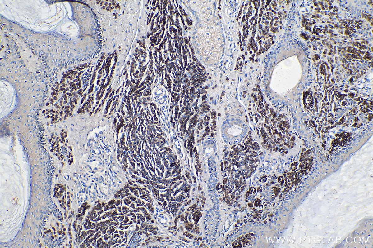 Immunohistochemical analysis of paraffin-embedded human malignant melanoma tissue slide using KHC0275 (Melan-A IHC Kit).