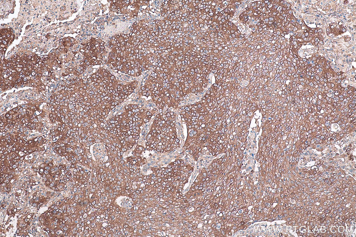 Immunohistochemical analysis of paraffin-embedded human lung cancer tissue slide using KHC0950 (NAA10/ARD1A IHC Kit).