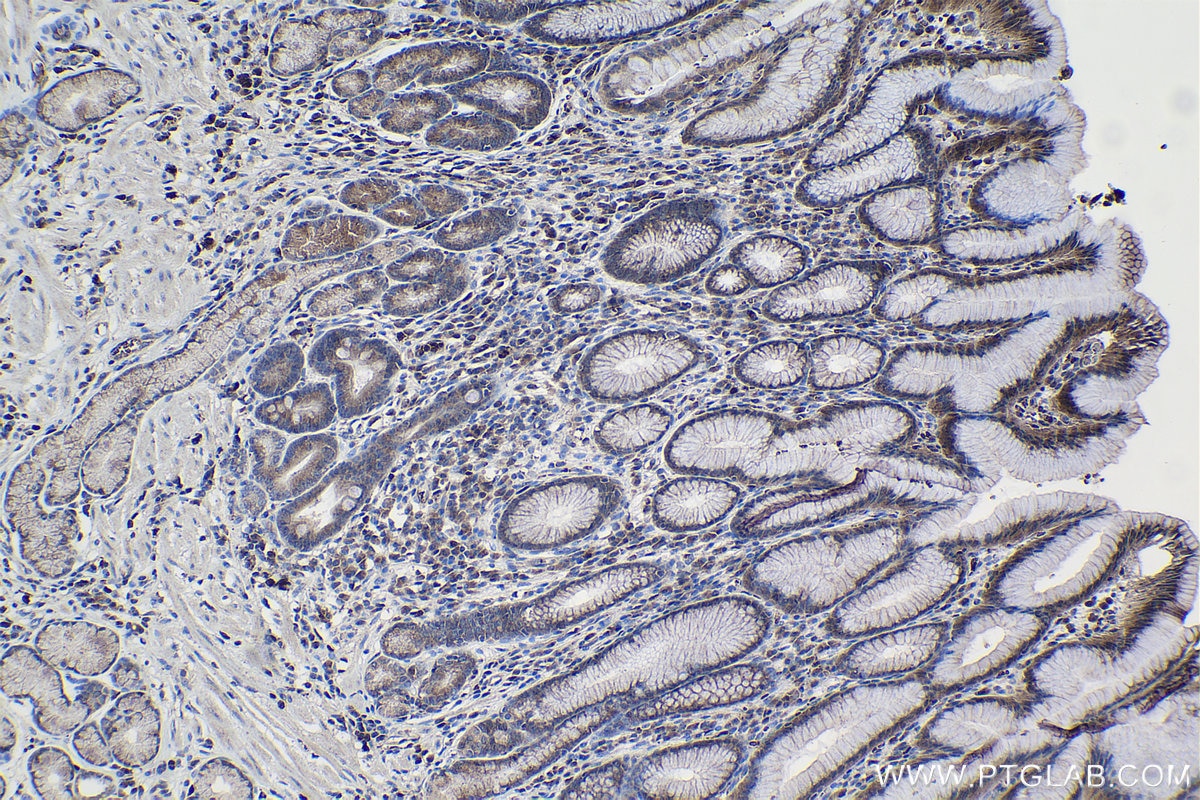 Immunohistochemical analysis of paraffin-embedded human stomach cancer tissue slide using KHC0991 (NAA15/NARG1 IHC Kit).