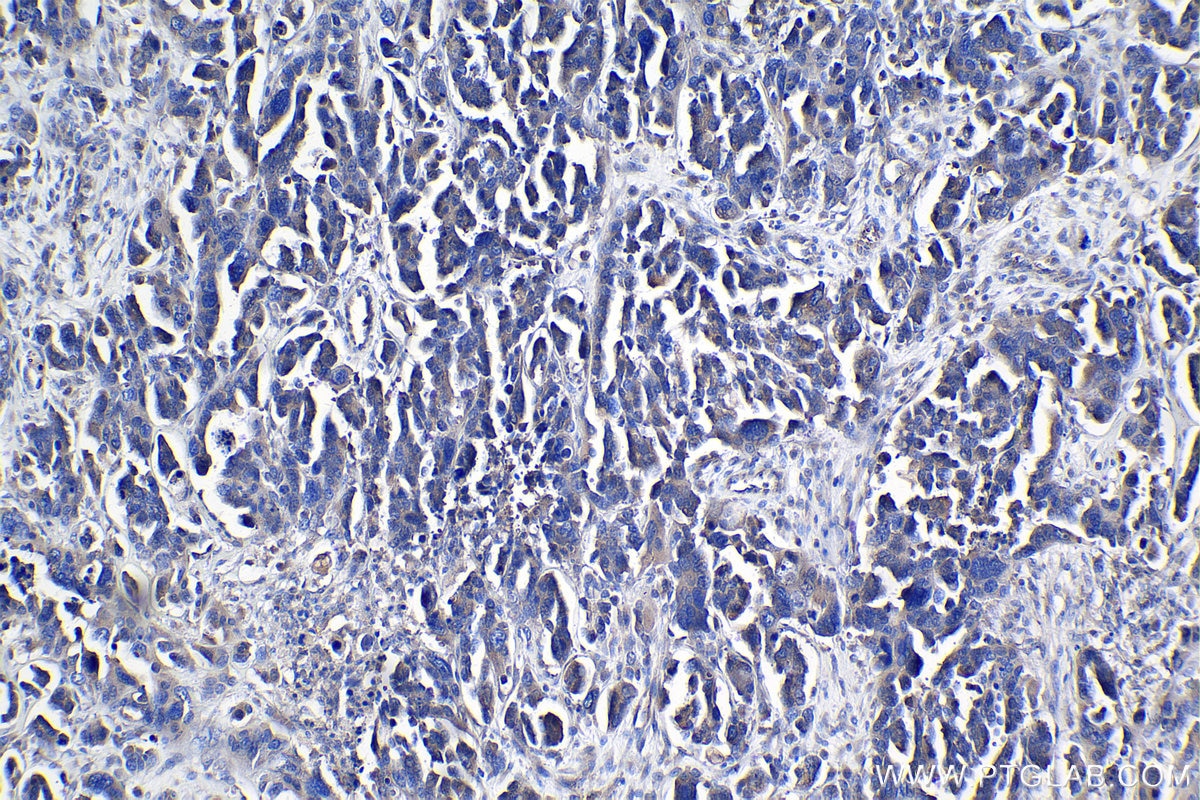 Immunohistochemical analysis of paraffin-embedded human colon cancer tissue slide using KHC0991 (NAA15/NARG1 IHC Kit).