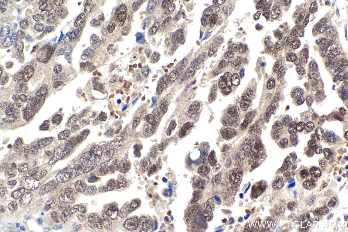 Immunohistochemical analysis of paraffin-embedded human ovary tumor tissue slide using KHC1882 (NACC1 IHC Kit).