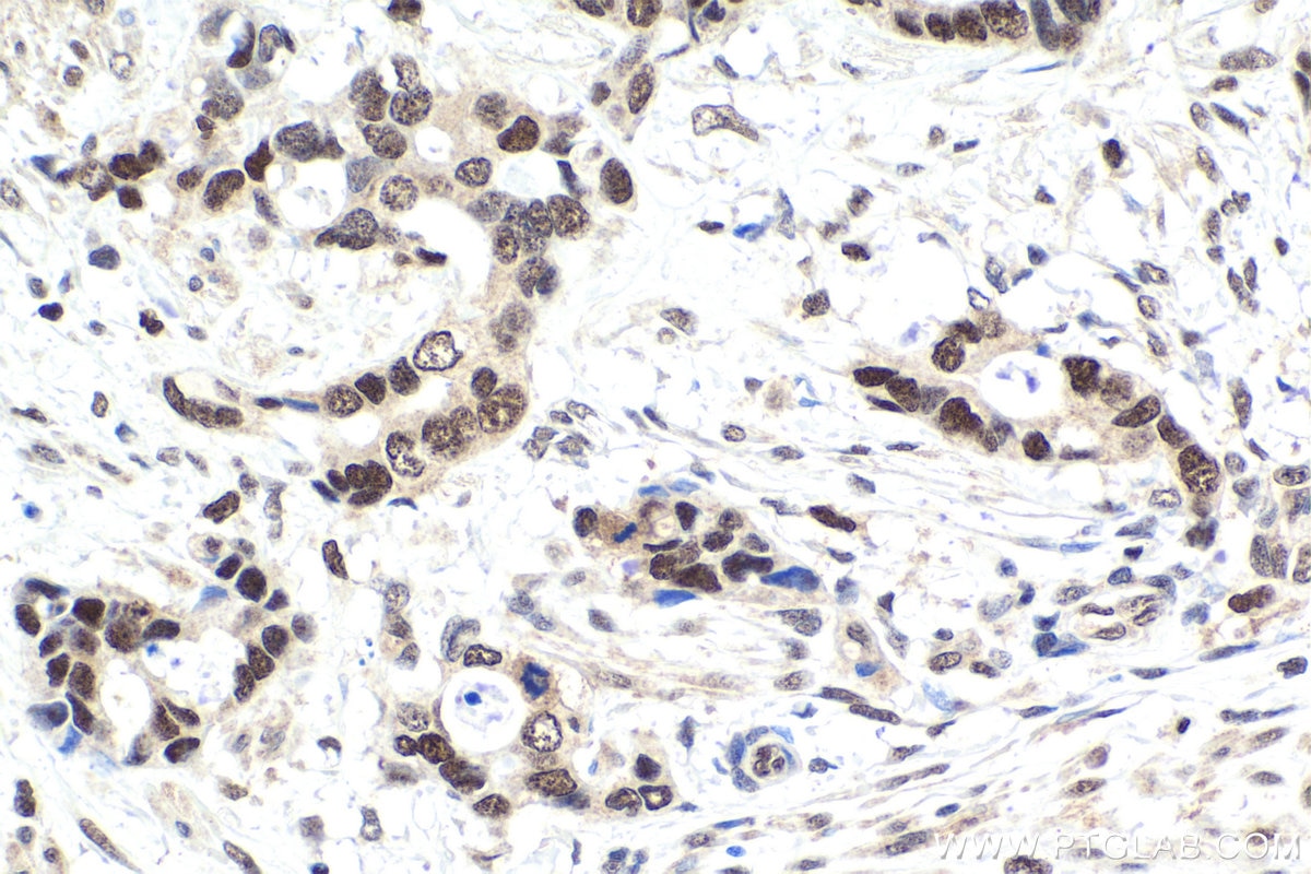 Immunohistochemical analysis of paraffin-embedded human urothelial carcinoma tissue slide using KHC1882 (NACC1 IHC Kit).