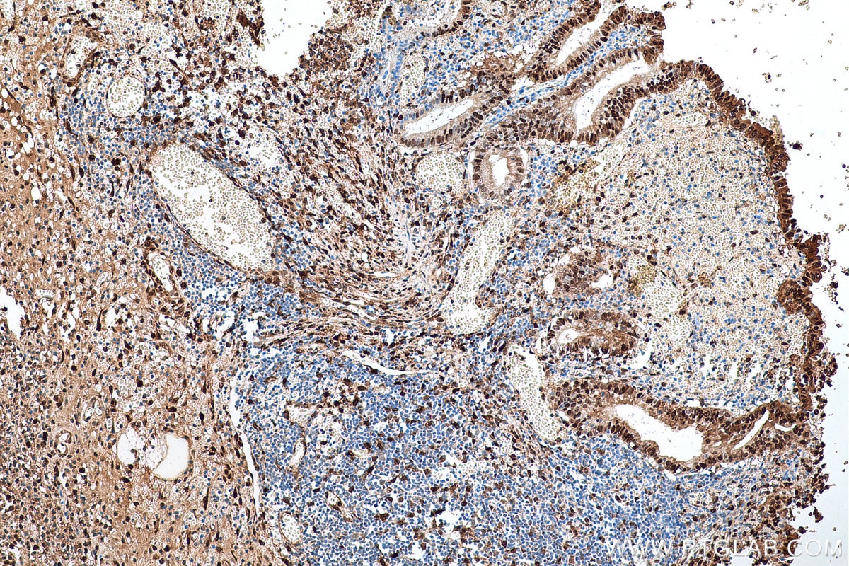 Immunohistochemical analysis of paraffin-embedded human appendicitis tissue slide using KHC0644 (NAMPT/PBEF IHC Kit).