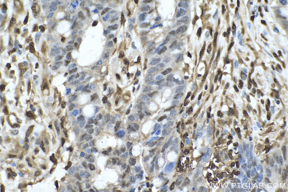 Immunohistochemical analysis of paraffin-embedded human colon cancer tissue slide using KHC0644 (NAMPT/PBEF IHC Kit).