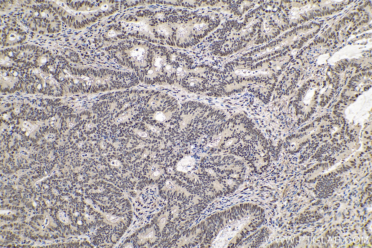 Immunohistochemical analysis of paraffin-embedded human colon cancer tissue slide using KHC0681 (NANS IHC Kit).