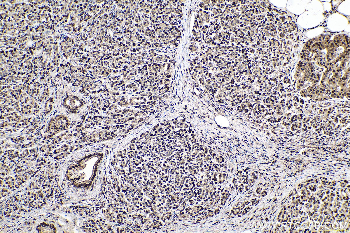 Immunohistochemical analysis of paraffin-embedded human pancreas cancer tissue slide using KHC0681 (NANS IHC Kit).