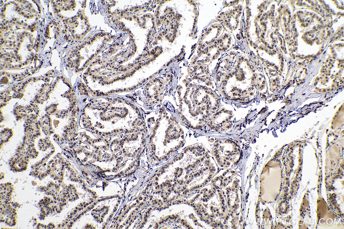 Immunohistochemical analysis of paraffin-embedded human thyroid cancer tissue slide using KHC0681 (NANS IHC Kit).