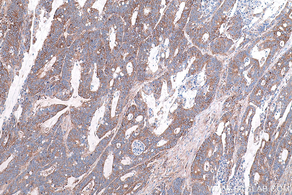 Immunohistochemical analysis of paraffin-embedded human colon cancer tissue slide using KHC0859 (NAP1L1 IHC Kit).