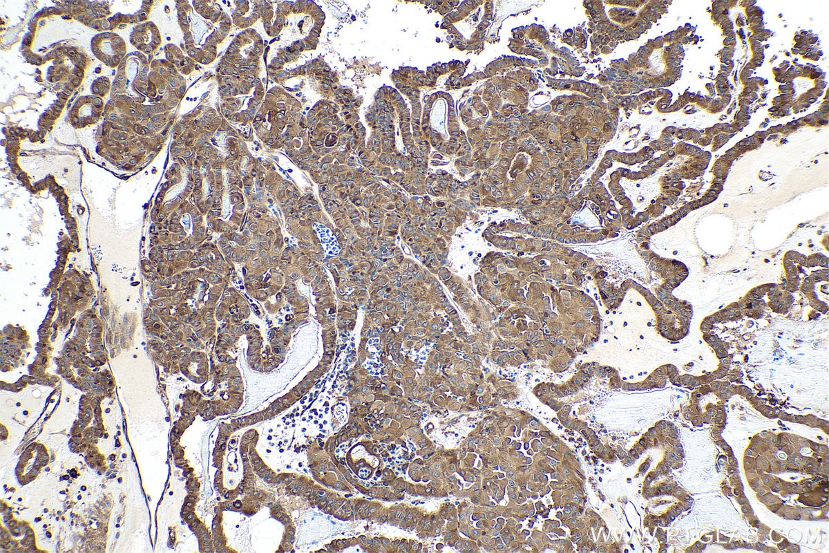 Immunohistochemical analysis of paraffin-embedded human thyroid cancer tissue slide using KHC0859 (NAP1L1 IHC Kit).