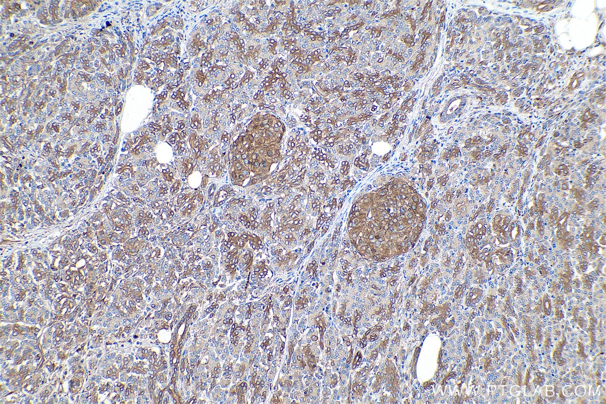 Immunohistochemical analysis of paraffin-embedded human pancreas cancer tissue slide using KHC0859 (NAP1L1 IHC Kit).