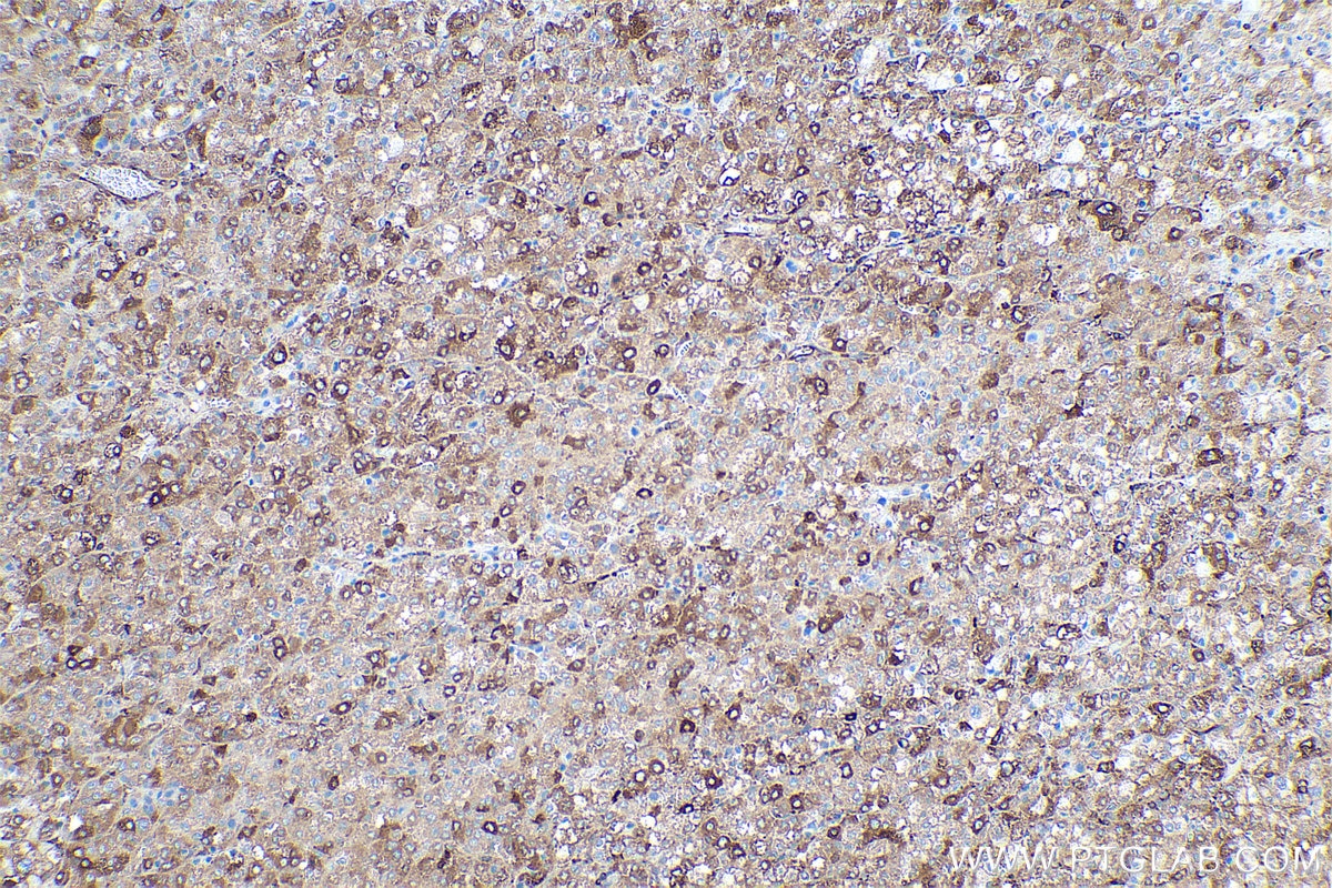 Immunohistochemical analysis of paraffin-embedded human liver cancer tissue slide using KHC0859 (NAP1L1 IHC Kit).