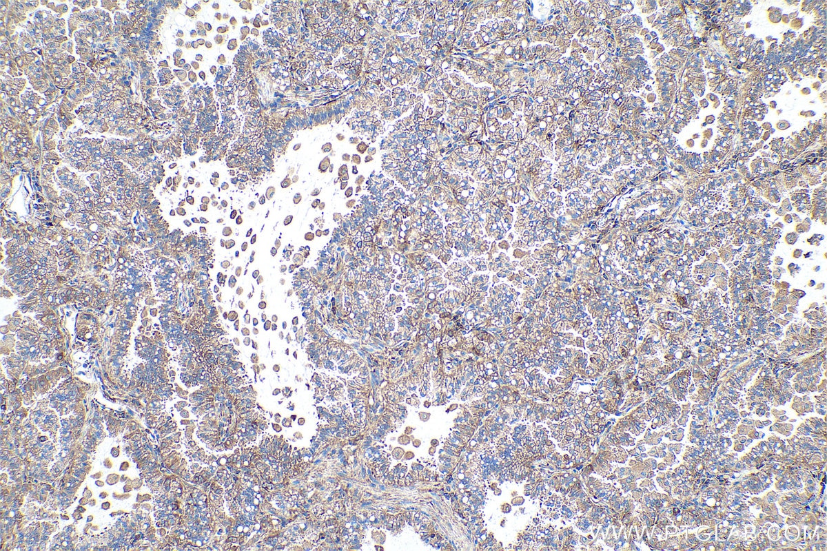 Immunohistochemical analysis of paraffin-embedded human lung cancer tissue slide using KHC0859 (NAP1L1 IHC Kit).