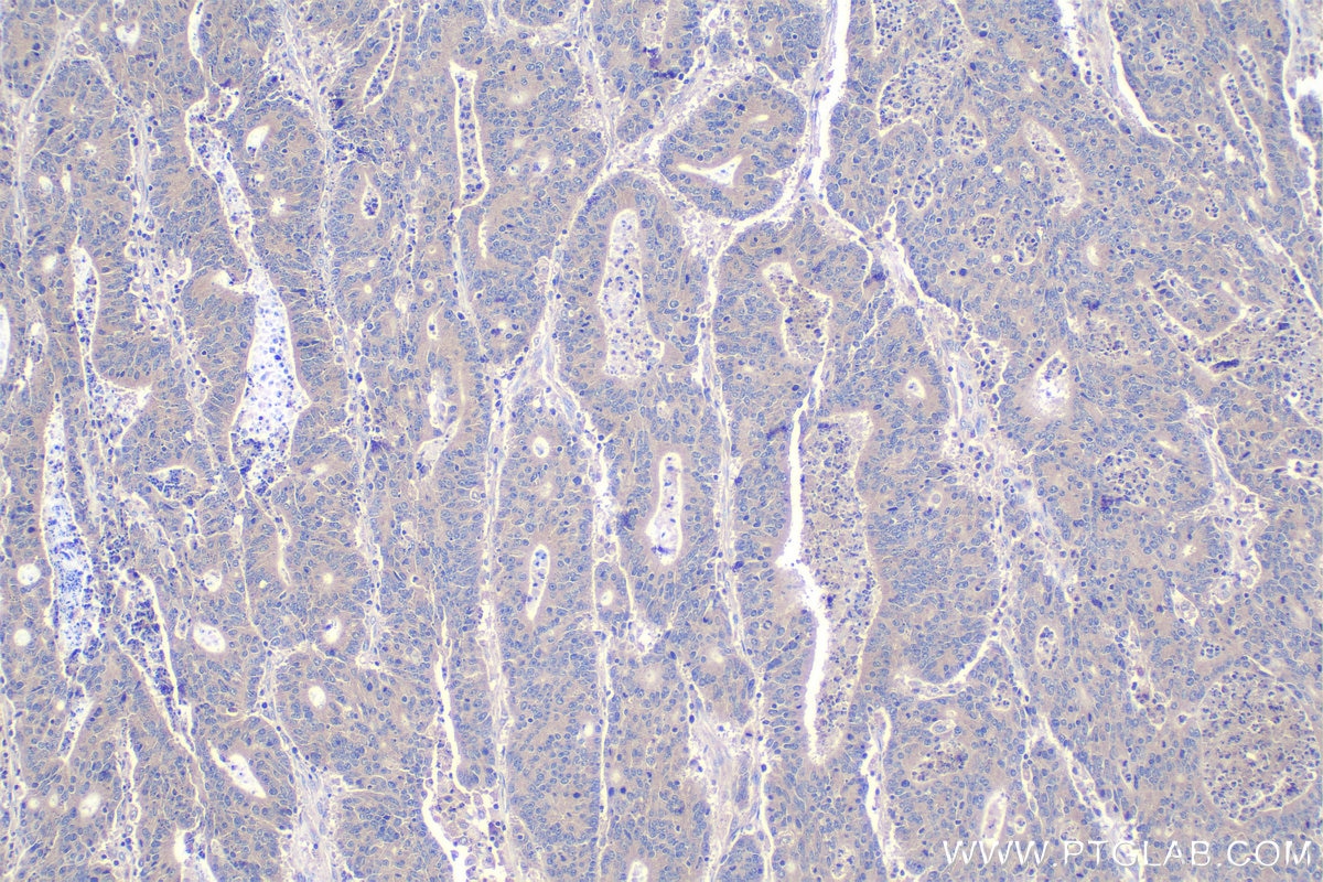 Immunohistochemical analysis of paraffin-embedded human colon cancer tissue slide using KHC1046 (NAPG IHC Kit).