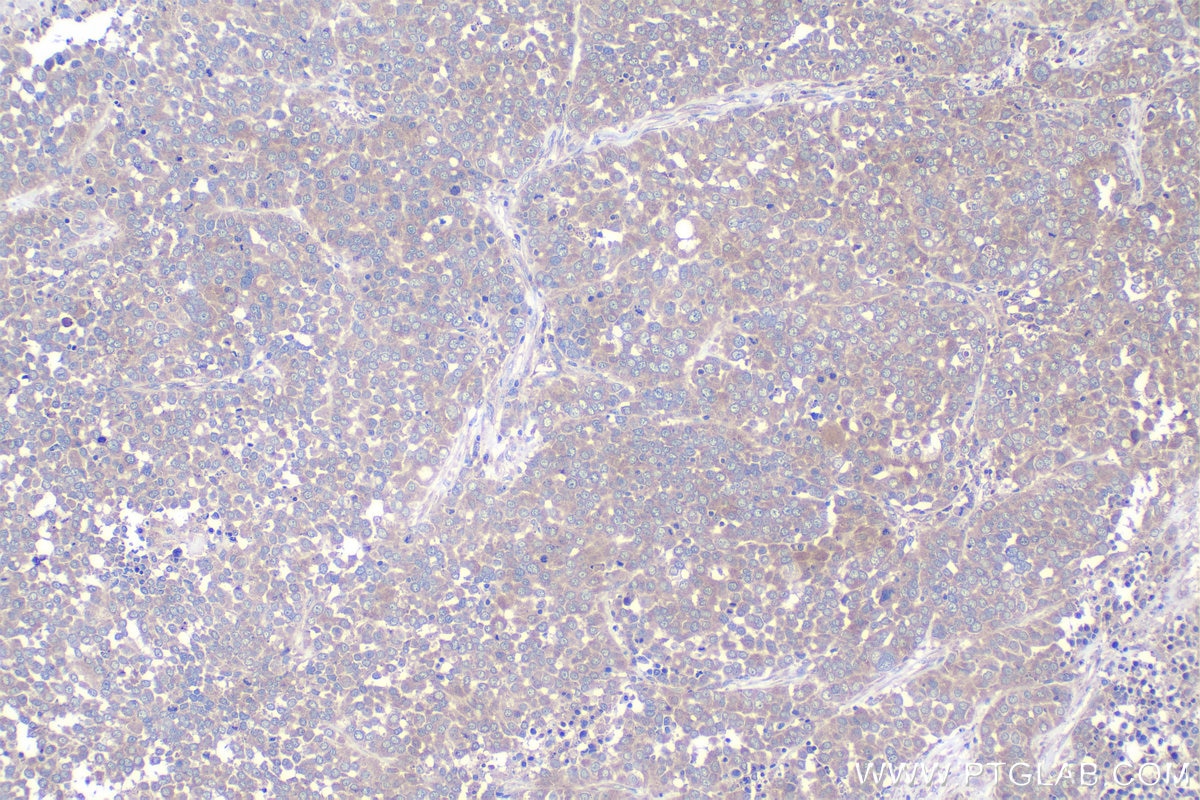 Immunohistochemical analysis of paraffin-embedded human ovary tumor tissue slide using KHC1046 (NAPG IHC Kit).