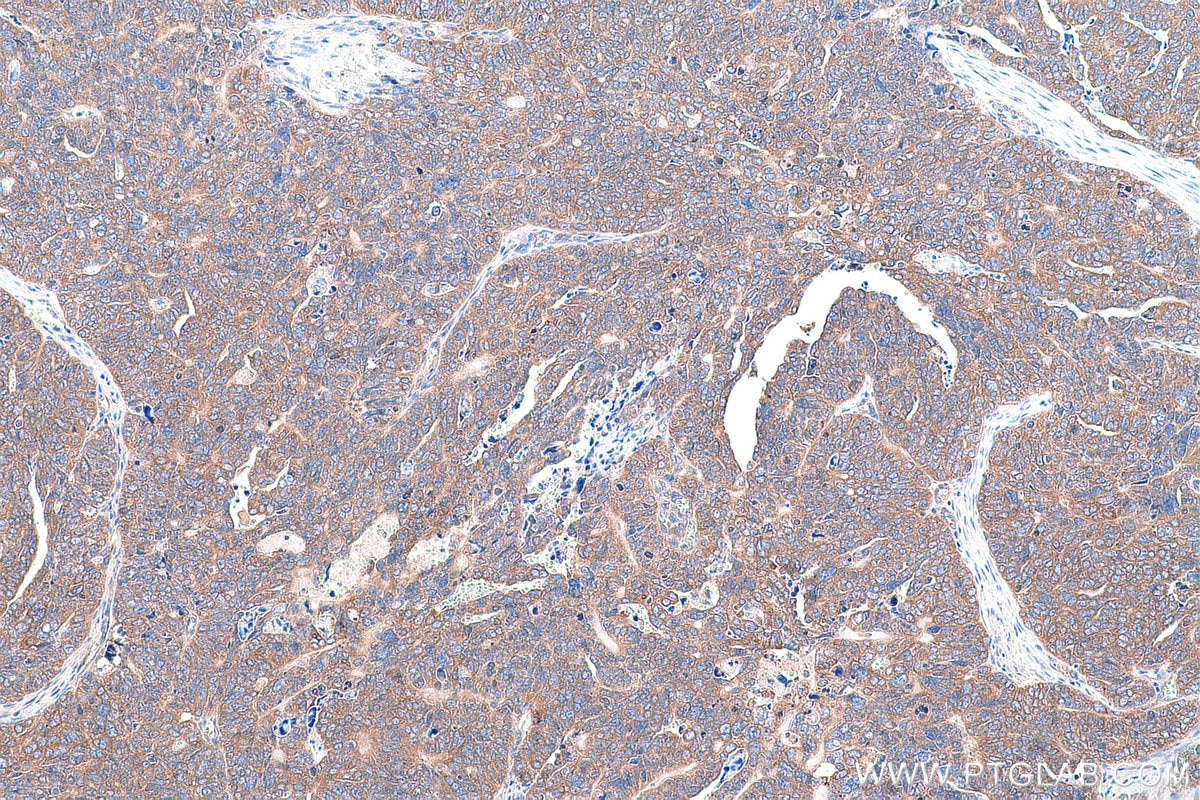 Immunohistochemical analysis of paraffin-embedded human ovary tumor tissue slide using KHC0907 (NARS IHC Kit).