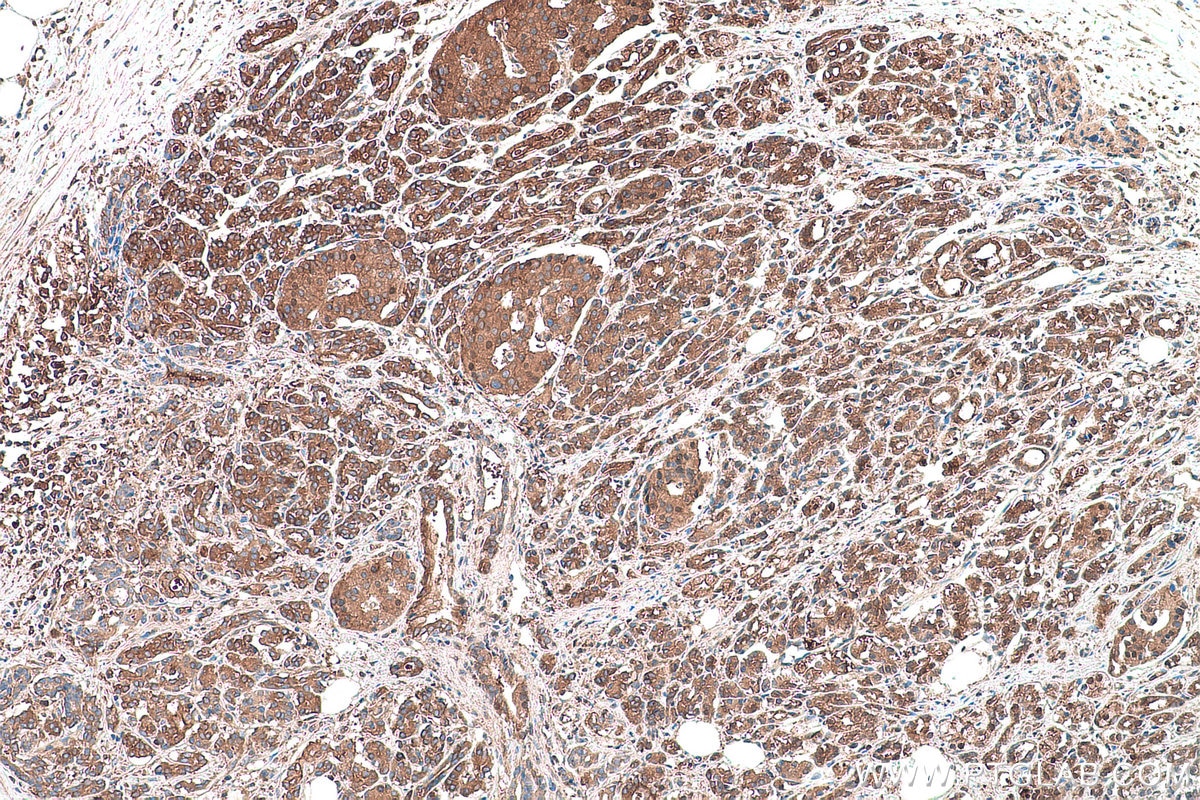 Immunohistochemical analysis of paraffin-embedded human pancreas cancer tissue slide using KHC0907 (NARS IHC Kit).