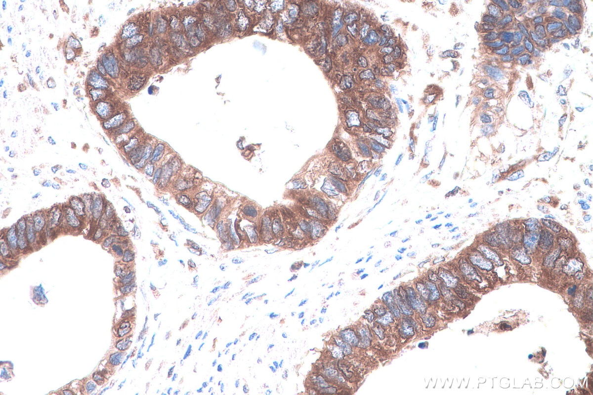 Immunohistochemical analysis of paraffin-embedded human urothelial carcinoma tissue slide using KHC0907 (NARS IHC Kit).