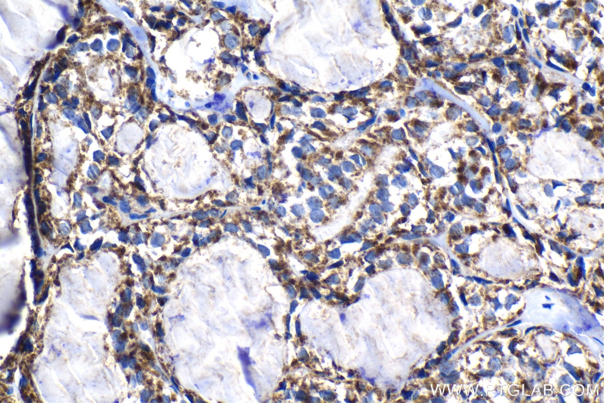 Immunohistochemical analysis of paraffin-embedded human thyroid cancer tissue slide using KHC1298 (NARS2 IHC Kit).