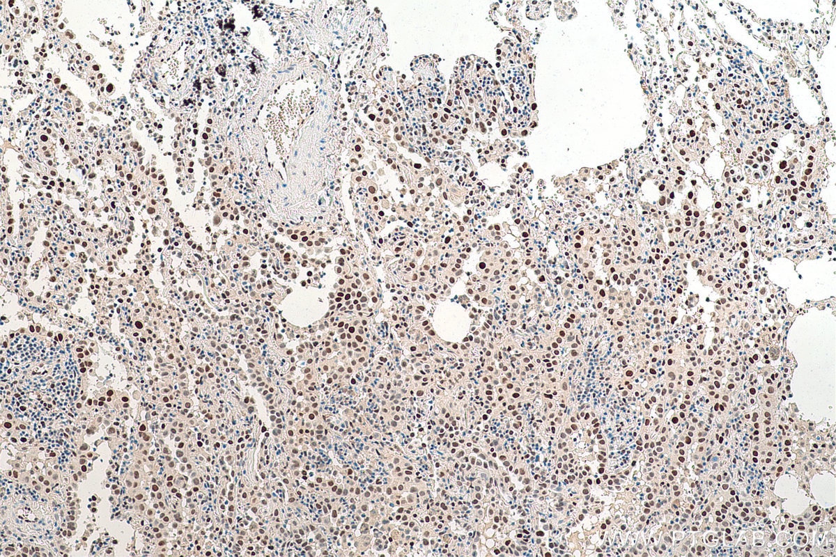 Immunohistochemical analysis of paraffin-embedded human lung cancer tissue slide using KHC0842 (NASP IHC Kit).