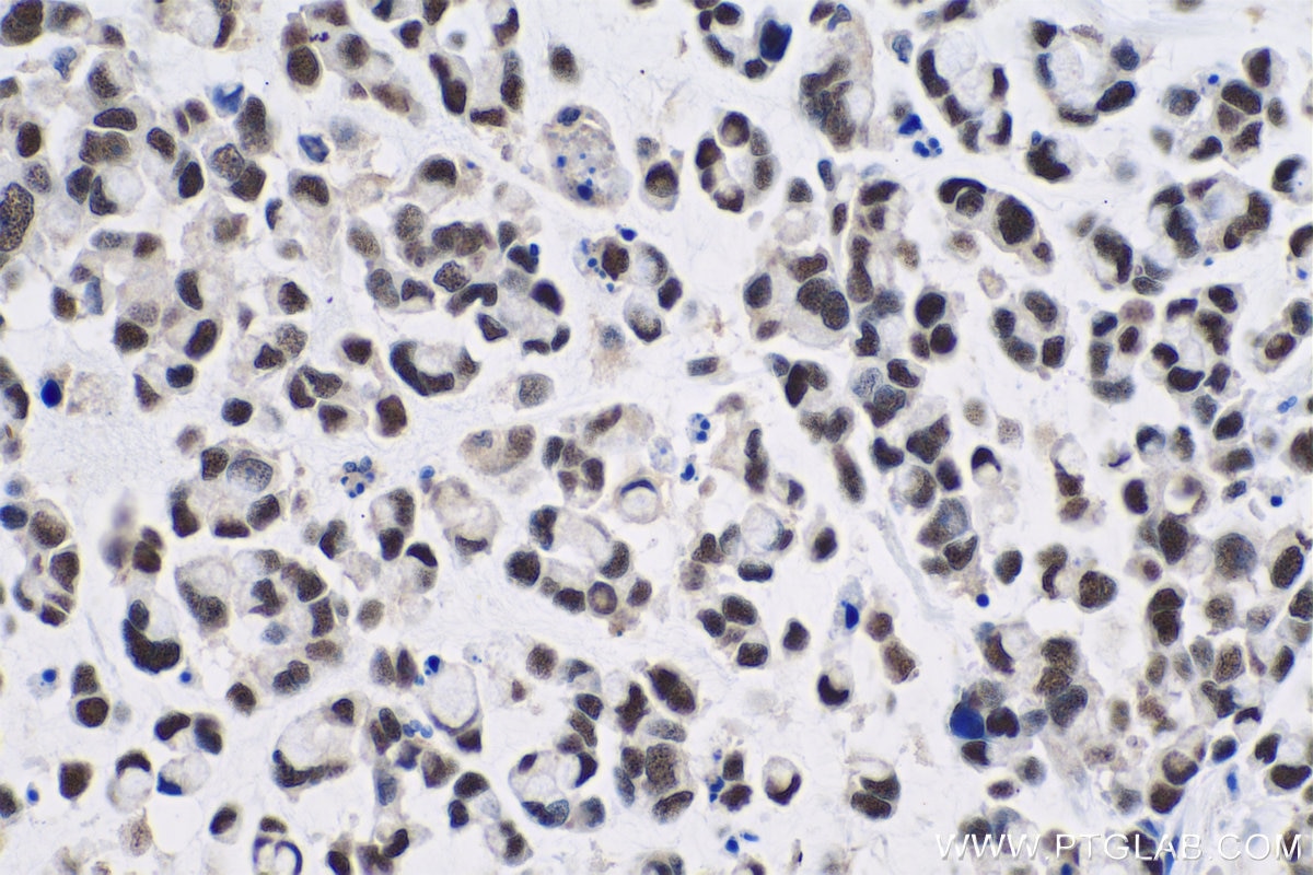 Immunohistochemical analysis of paraffin-embedded human colon cancer tissue slide using KHC0842 (NASP IHC Kit).