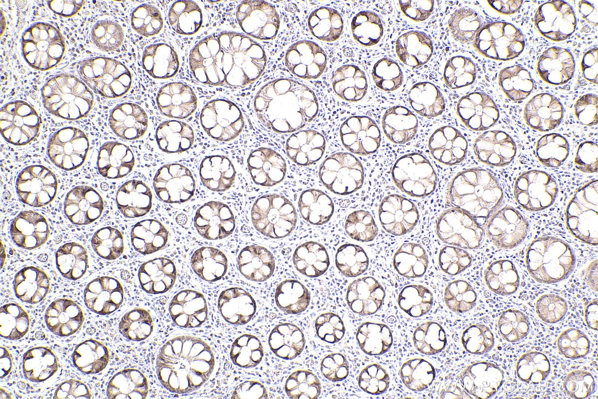 Immunohistochemical analysis of paraffin-embedded human rectal cancer tissue slide using KHC2474 (NCAPH IHC Kit).