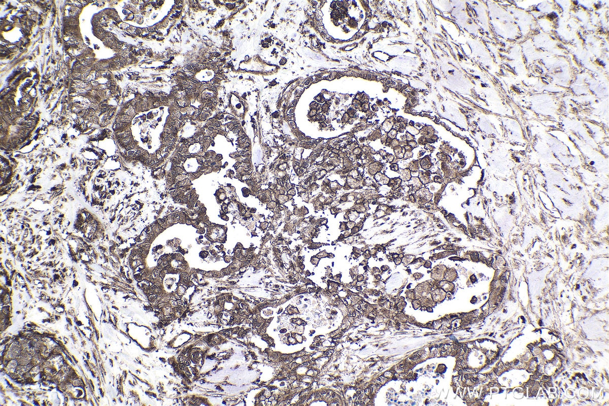 Immunohistochemical analysis of paraffin-embedded human pancreas cancer tissue slide using KHC1687 (NCBP1 IHC Kit).