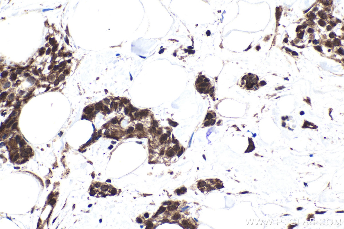 Immunohistochemical analysis of paraffin-embedded human urothelial carcinoma tissue slide using KHC1687 (NCBP1 IHC Kit).