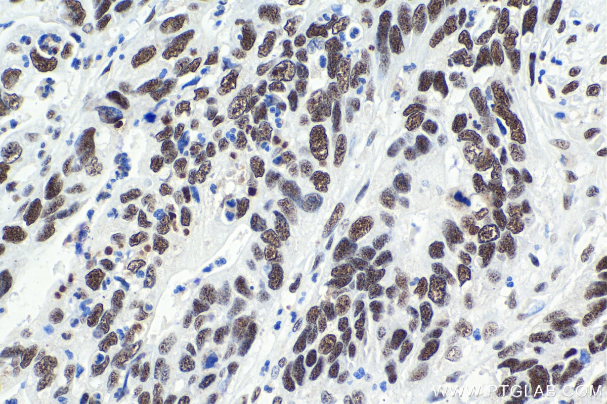 Immunohistochemical analysis of paraffin-embedded human stomach cancer tissue slide using KHC1621 (NCBP2 IHC Kit).
