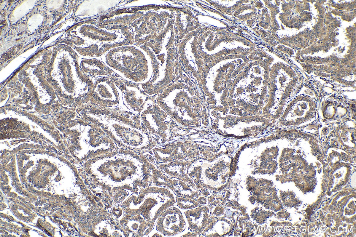 Immunohistochemical analysis of paraffin-embedded human thyroid cancer tissue slide using KHC1537 (NCK1 IHC Kit).