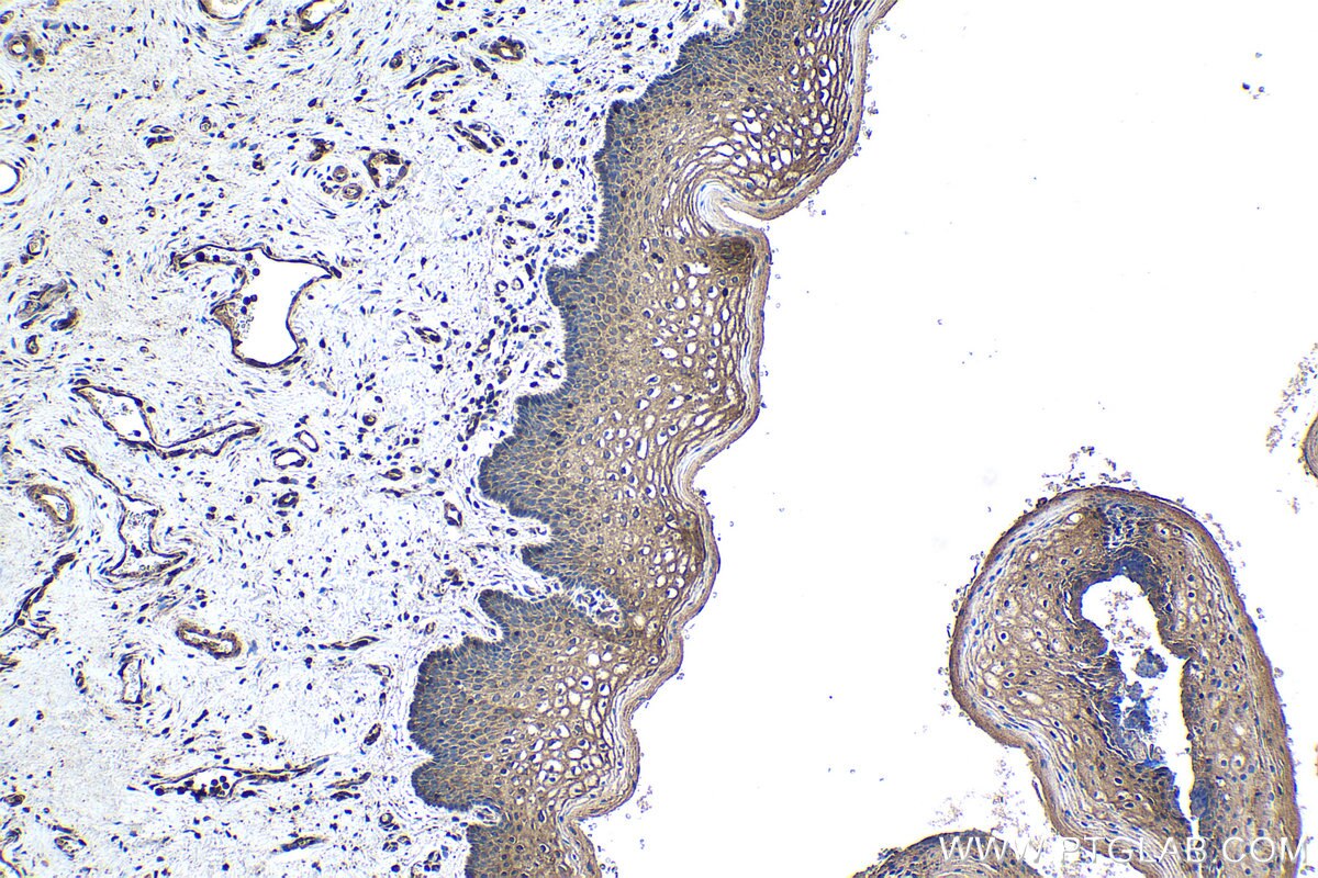 Immunohistochemical analysis of paraffin-embedded human cervical cancer tissue slide using KHC1537 (NCK1 IHC Kit).