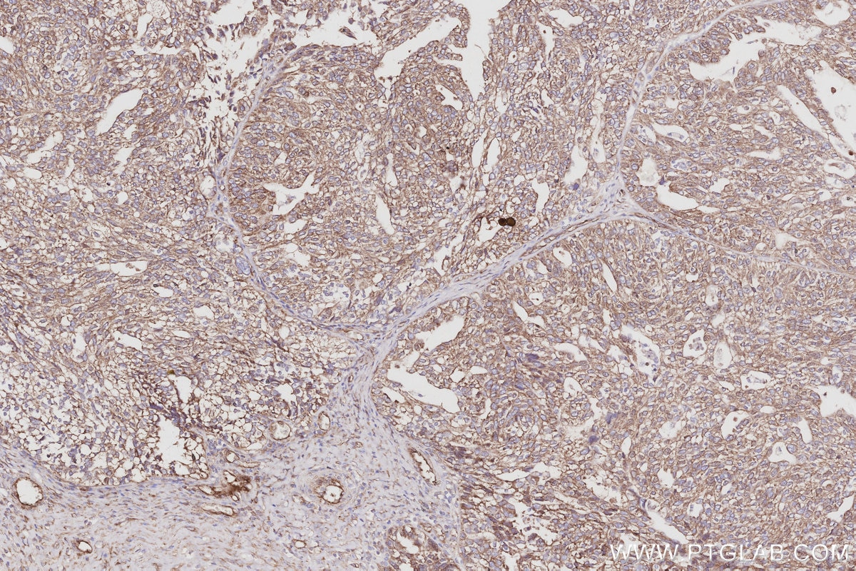 Immunohistochemical analysis of paraffin-embedded human ovary cancer tissue slide using KHC3053 (NCKAP1 IHC Kit). Immunohistochemical analysis of paraffin-embedded human ovary cancer tissue slide using KHC3053 (NCKAP1 IHC Kit).
