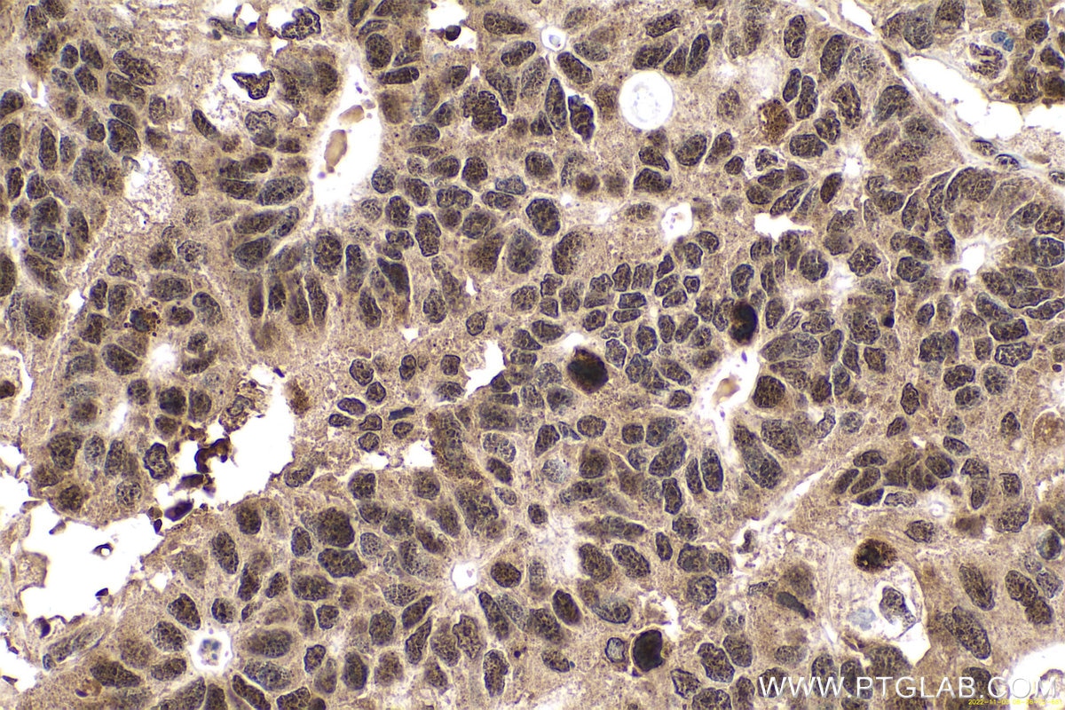 Immunohistochemical analysis of paraffin-embedded human stomach cancer tissue slide using KHC0661 (NCL IHC Kit).