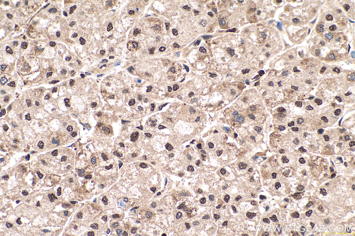 Immunohistochemical analysis of paraffin-embedded human liver cancer tissue slide using KHC0661 (NCL IHC Kit).