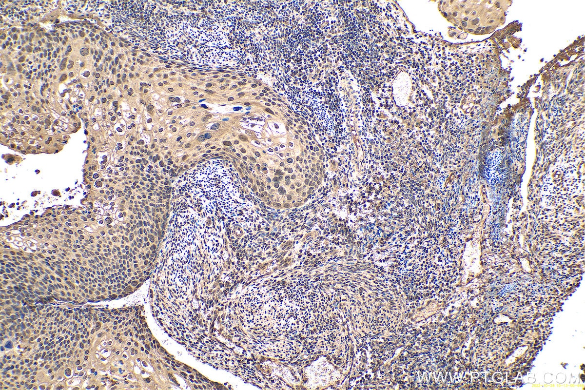 Immunohistochemical analysis of paraffin-embedded human cervical cancer tissue slide using KHC0661 (NCL IHC Kit).